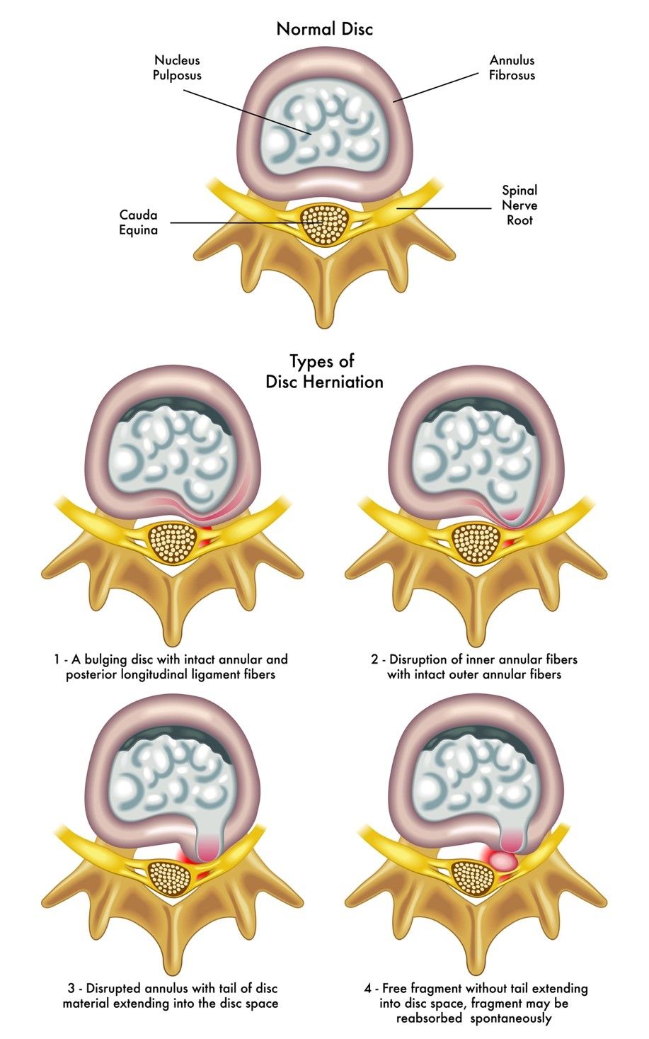 HERNIATED DISC